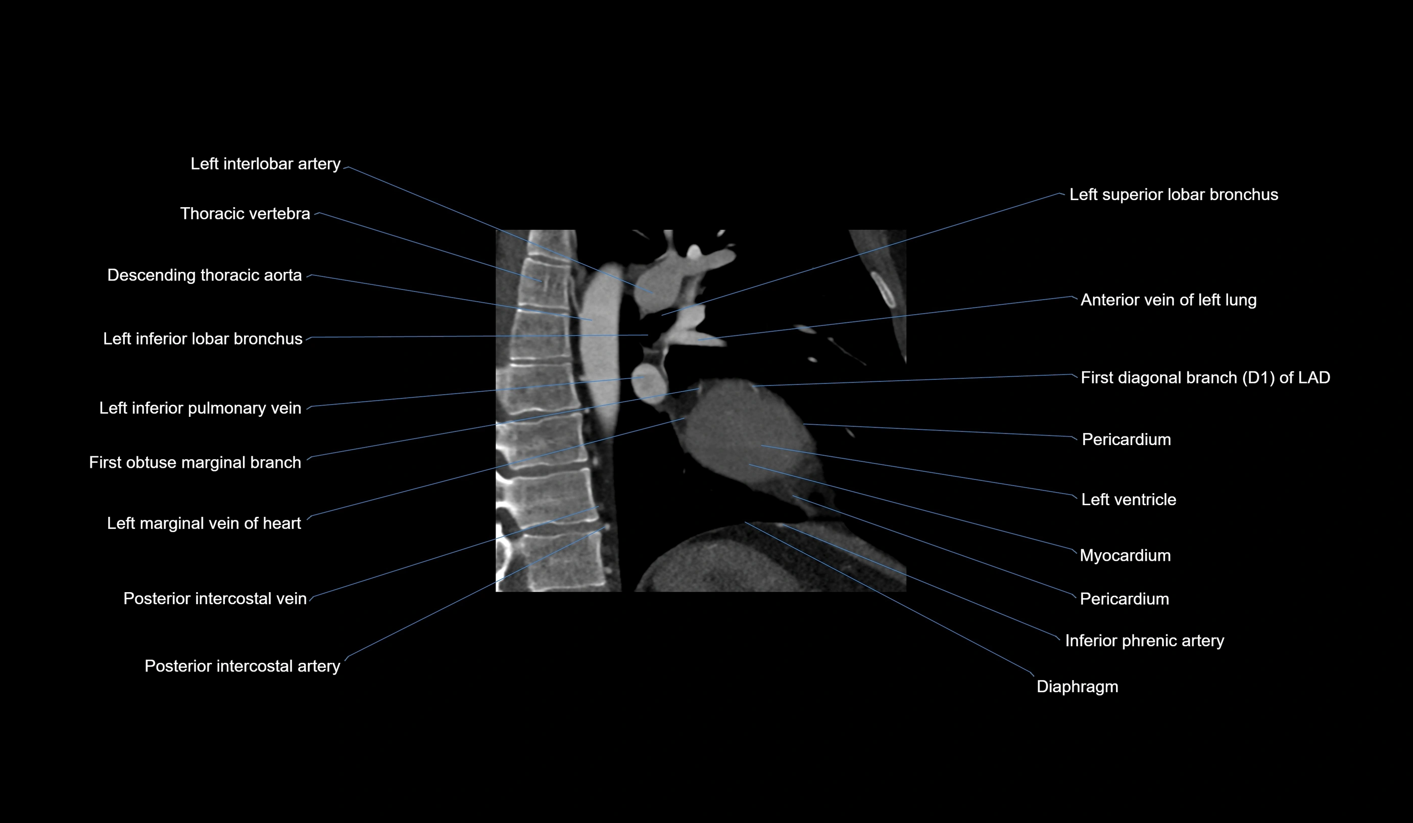 CT heart (coronary angiogram) 2 chamber view cross sectional anatomy labelled radiology image-00005.webp